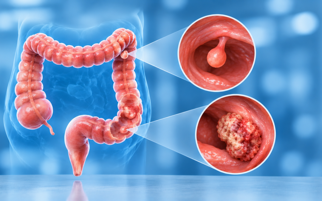 Diagram of the large intestine with two magnified views showing a colon polyp and a tumor disease marker.