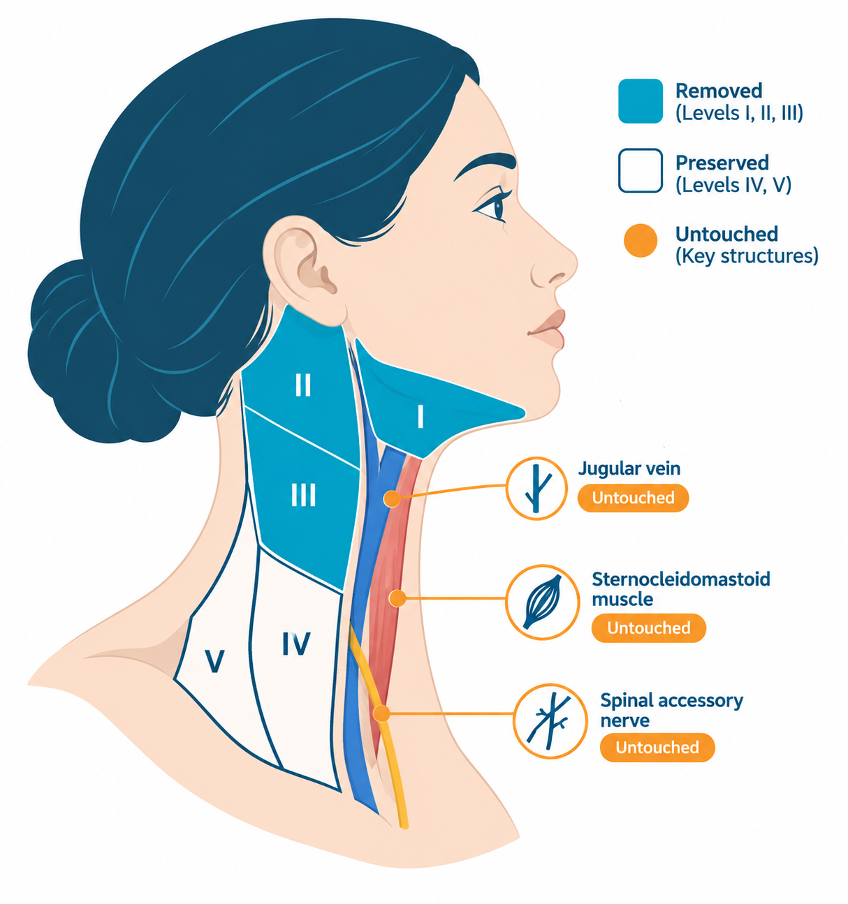 what is a selective neck dissection?