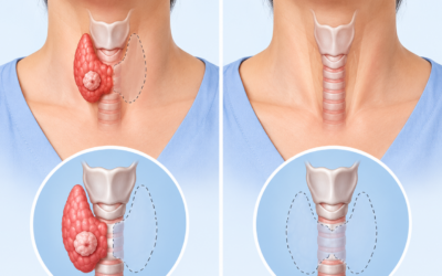 Hemithyroidectomy vs Total Thyroidectomy for Papillary Thyroid Cancer