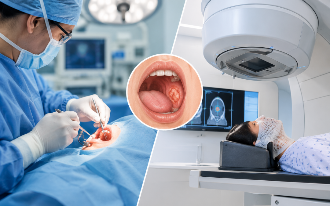 Oral Cancer: Should Treatment Start with Surgery or Radiation?